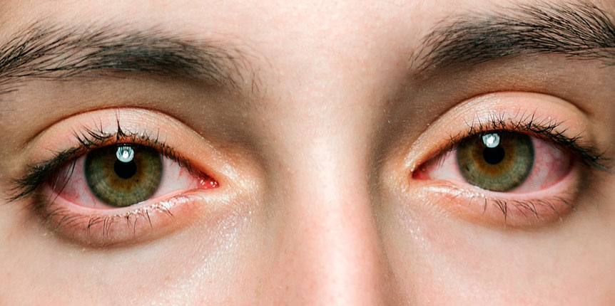 Collirio per occhi rossi e terapia anti-glaucoma
