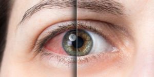 Occhi irritati: cause e soluzioni