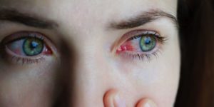 Scopri di più sull'articolo Collirio per congiuntivite allergica e blefarite