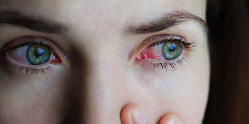 Scopri di più sull'articolo Collirio per congiuntivite allergica e blefarite