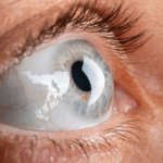 Antiedemigeni: come combattere l’edema corneale con soluzioni oftalmiche