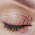 Dermatite perioculare: come combatterla con gli spray