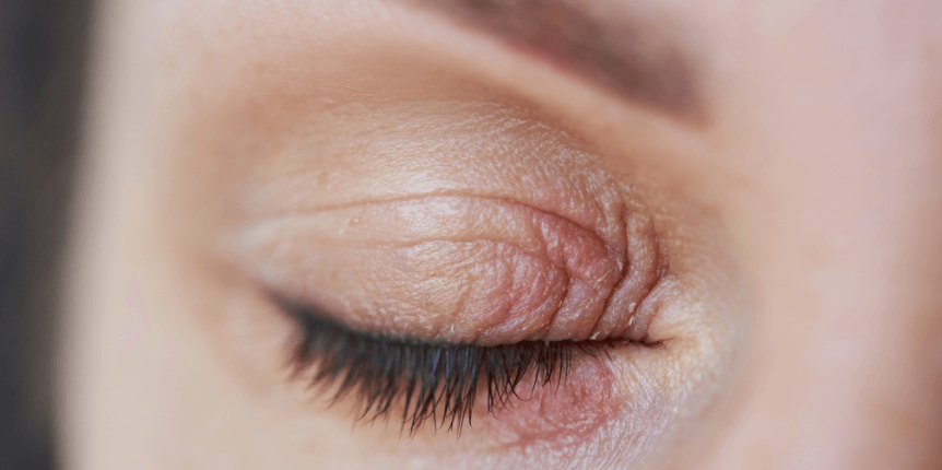 Scopri di più sull'articolo Dermatite perioculare: come combatterla con gli spray